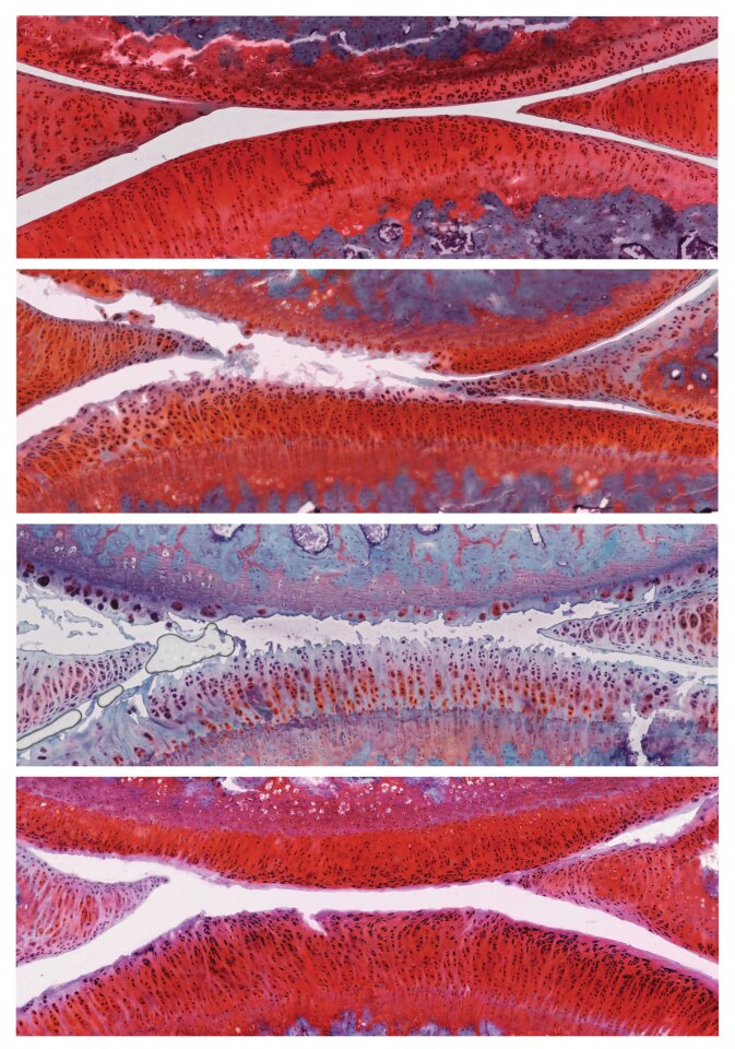 (Image 1) A healthy rat's knee joint. (Image 2) a joint with grade 2 osteoarthritis. (Image 3) a control group knee that has worsened to grade 4 osteoarthritis. (Image 4) a treated rat's knee joint, which has improved to grade 1 (mild) after receiving the drug combo